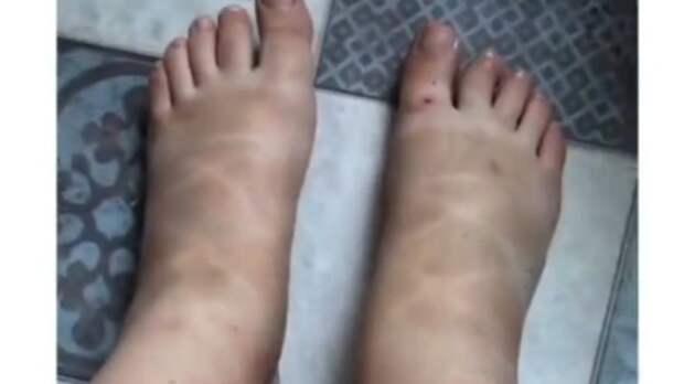 Мне страшно: женщина показала, что стало с её ногами после купания во Владивостоке