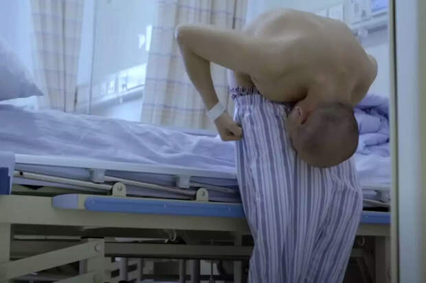 LADBible: китайские хирурги прооперировали мужчину, который 28 лет жил согнувшись пополам