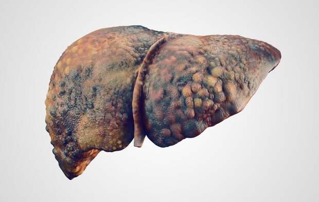 shutterstock_511062427-liver-disease-eranicle