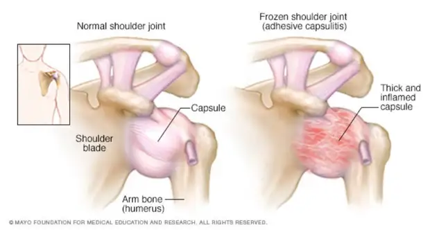 Frozen Shoulder Physical Therapy – Will My Insurance Cover It?