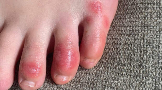 Новый симптом коронавируса - появляется на ногах