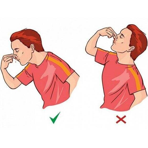 Как правильно останавливать кровотечение из носа