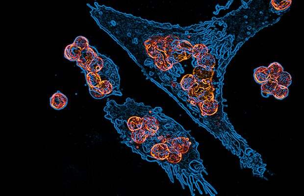 Человеческие клетки — макрофаги (голубые) захватили клетки опухоли (оранжевые), которые перед этим пометили антителами, которые служат иммунным клеткам опознавательными знаками. Ученые работают над тем, чтобы закрепить антитела на раковых клетках.