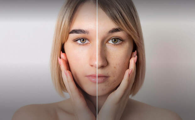 Как правильно и эффективно лечить акне? Можно ли начинать лечение летом?