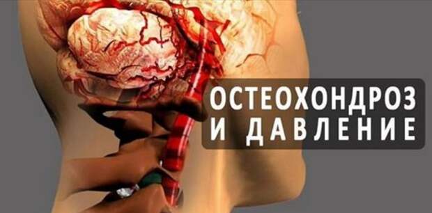 Остеохондроз шеи и перепады давления всегда неразлучный союз Остеохондроз шеи и перепады давления всегда неразлучный союз