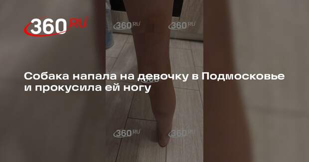 Жительница Одинцова рассказала, как собака покусала ее дочь на детской площадке