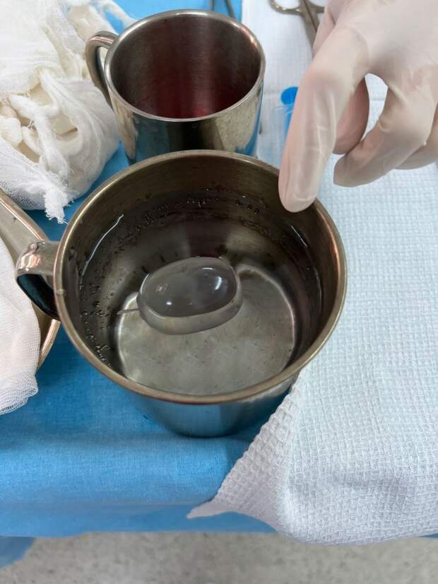 Хирурги Самарского государственного медицинского университета начали выполнять сложные операции по протезированию в области урологии. Протезирование яичка выполняется крайне редко и требует высокой квалификации хирургической бригады. Такое вмешательство показано при врождённой патологии или после удаления одного из яичек по какой-либо причине.
