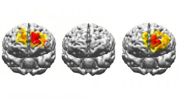 Электростимуляция мозга улучшила память пожилых людей (4 фото)