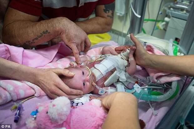 Британские врачи спасли девочку, родившуюся с сердцем вне тела врачи, дети, младенец, новости, операция, патология, сердце, фото