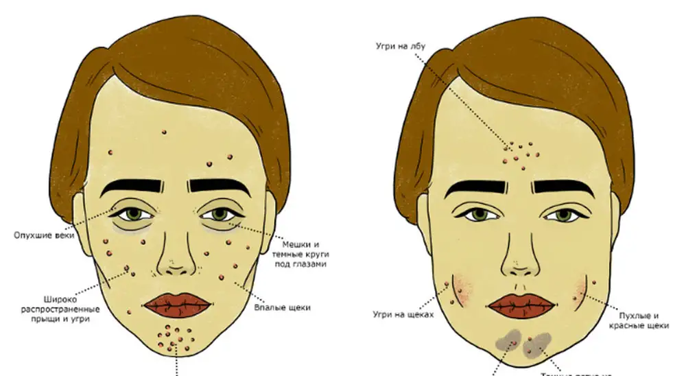 Что означает место прыщей. Схема прыщей на лице. Прыщи на лице причины. Типы угревой сыпи на лице. Карта прыщей на лице.