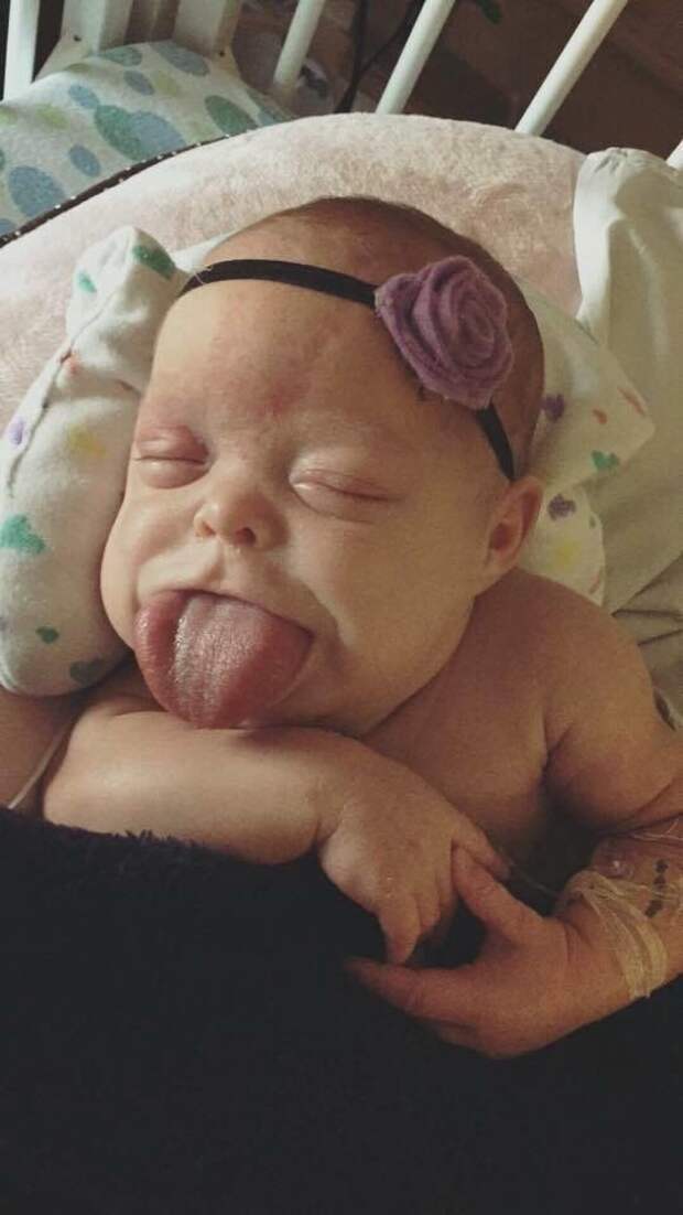At a doctor's recommendation, Paisley received her first tongue reduction surgery at six months and a second one at 13 months.
