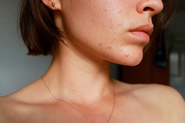 Врач Абалухова: обострение акне летом связано с воздействием на кожу УФ-лучей