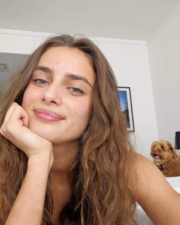 Не надо стесняться! Ангел Victoria's Secret показывает свое лицо с акне
