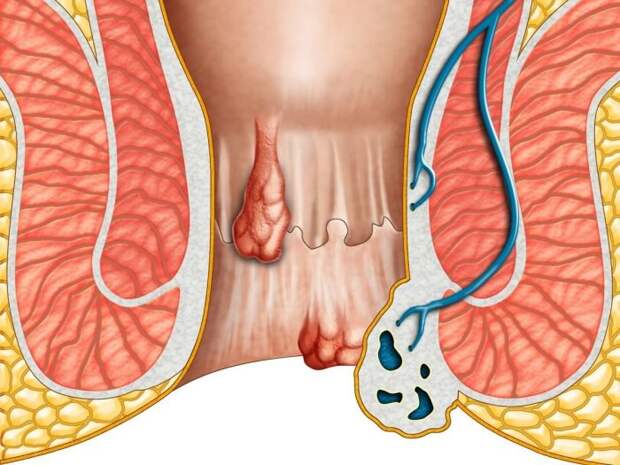Что такое геморроидэктомия по Миллигану-Моргану