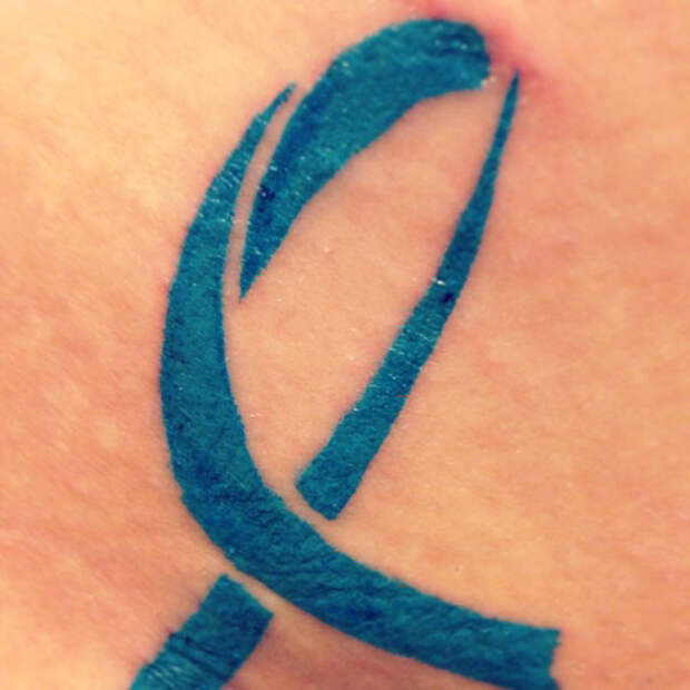 The Symbol For Ovarian Cancer Following A Lumpectomy