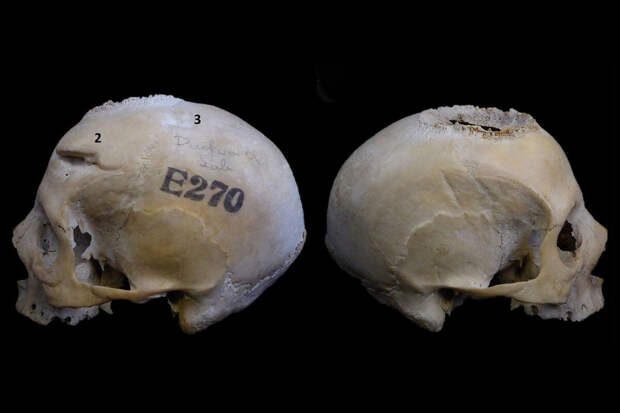 FIM: египетские врачи вырезали метастазы из черепа пациента 4 тыс. лет назад