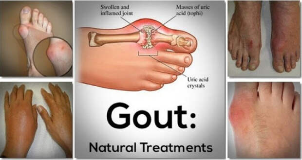 say-goodbye-to-gout-forever-with-this-powerful-natural-treatment