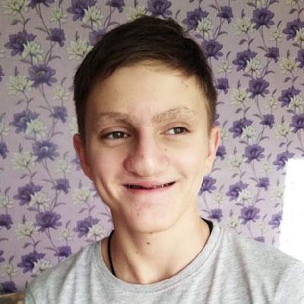 Влад Ясаков, 16 лет, расщелина альвеолярного отростка, сужение челюсти, требуется ортодонтическое лечение, 212 733 ₽