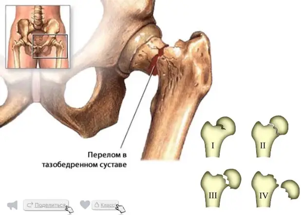 Где находится шейка бедра рисунок