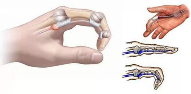 Ударно-волновая терапия (УВТ) как эффективный метод лечения стенозирующего лигаментита