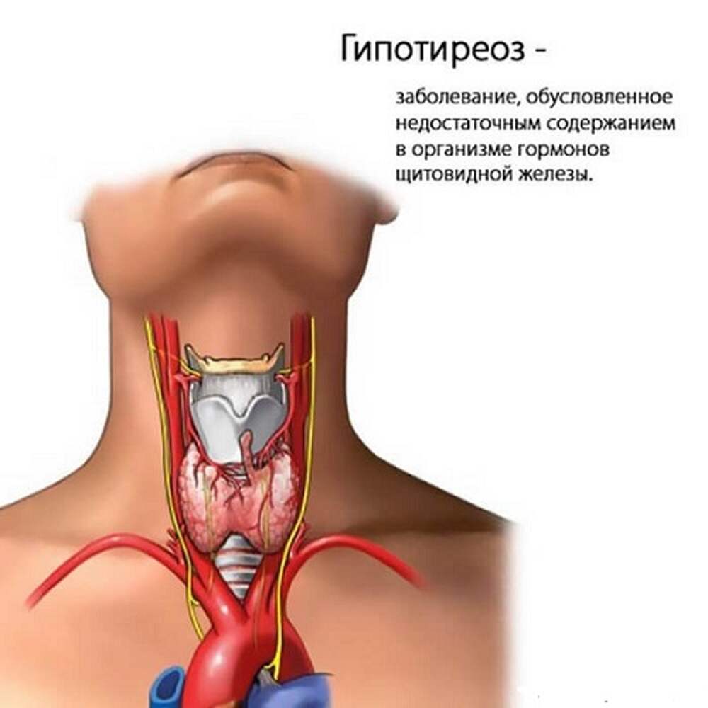Гипотиреоз щитовидной железы симптомы