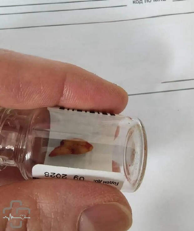 Российские врачи достали зуб пациента из неожиданного места