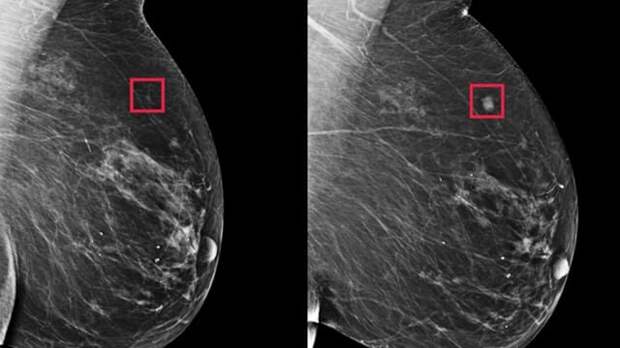 Самые ранние признаки рака молочной железы
