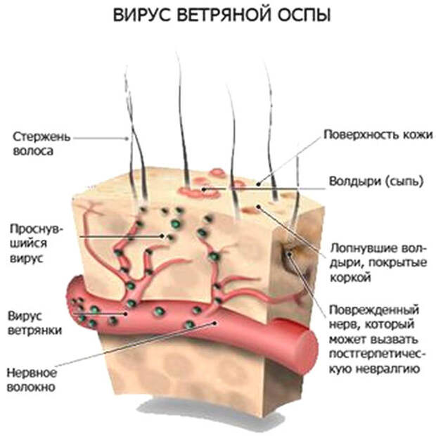 Развитие ветрянки