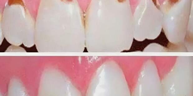 Невидимая угроза для улыбки: повседневные продукты, которые разрушают зубы