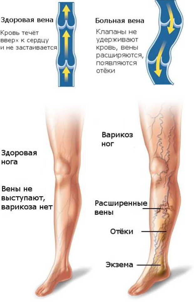 Сильно болит нога после операции. Варикозное расширение вен нижних конечностей классификация. Клиника и диагностика варикозного расширения вен нижних конечностей. Варикоз болит нога спереди. Варикоз на голени спереди.