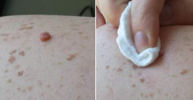 rub-natural-ingredient-skin-tags-will-disappear-no-time