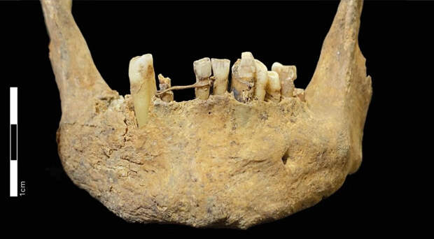 В Абердине нашли старейшую в Шотландии золотую зубную лигатуру