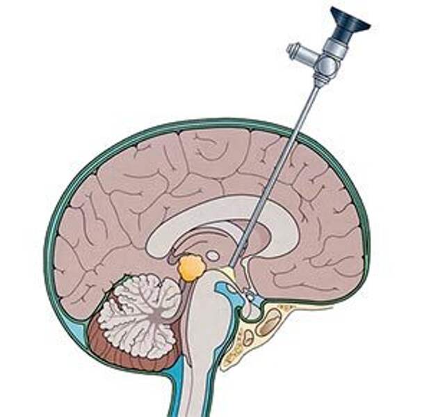 Шунт головного мозга. Шунтирование кисты в головном мозге. Шунтирование ликвора головного.