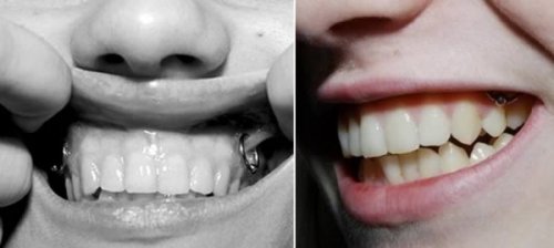 10 Самых экстремальных оральных пирсингов и модификаций тела