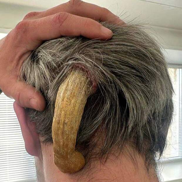 Хирурги из Татарстана удалили «дьявольский рог» у пациента