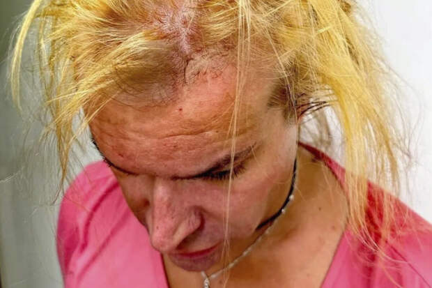 Шоумен Солнцев перенес первую из трех трансплантаций волос