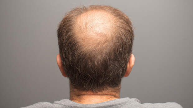 Почему выпадают волосы: врач развеяла популярные заблуждения