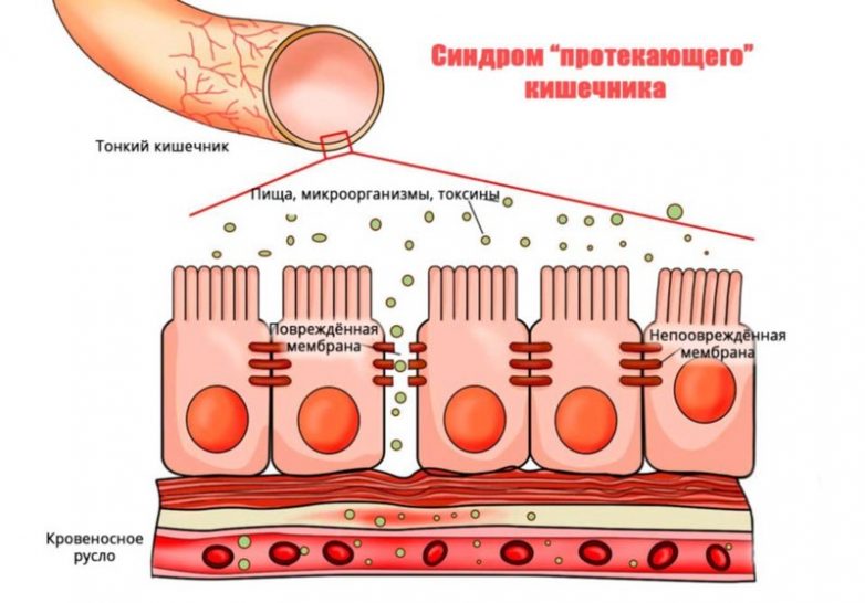 Синдром дырявого кишечника