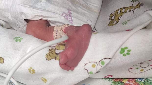 В одном из роддомов Владивостока мальчик родился с экстремально низкой массой тела – 900 граммов. На третьи сутки жизни у него выявили серьёзную патологию – перфорацию полого органа. Ребёнок находился в крайне тяжёлом состоянии на аппарате ИВЛ. Врачи роддома связались с реанимационной бригадой ГБУЗ «Краевая детская клиническая больница № 1» и на реанимобиле перевели туда ребенка. В отделении реанимации новорожденных ему провели минимальную предоперационную подготовку и отправили на оперативное лечение.