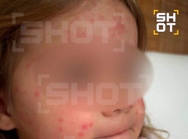 У девочки диагностировалии кожную инфекцию после укуса комара и купания на Бали