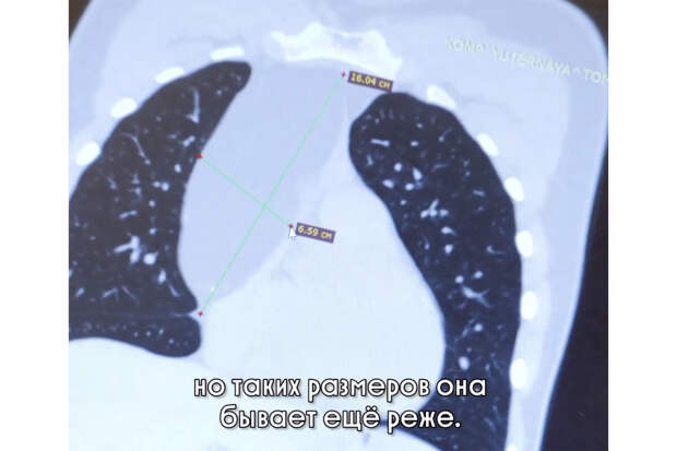 В Москве подростку удалили опухоль размером с кабачок