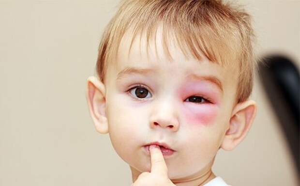 Мальчика укусила оса возле глаза
