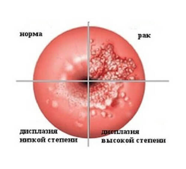 Симптомы дисплазии шейки матки. 