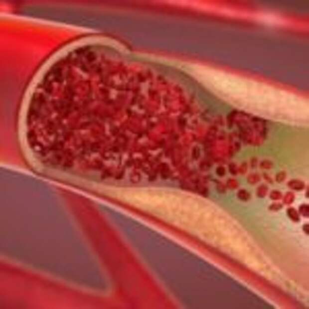 Создан гидрогель, способный остановить артериальное кровотечение