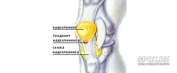 Медиальная фасетка надколенника на картинке