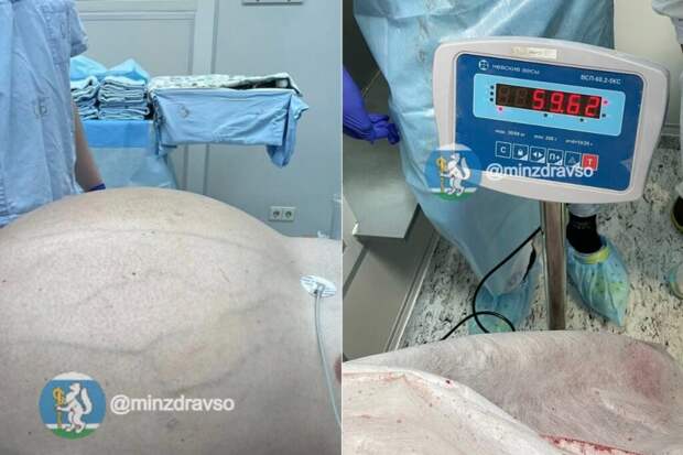 Опухоль в 60 кг удалили у жителя Свердловской области