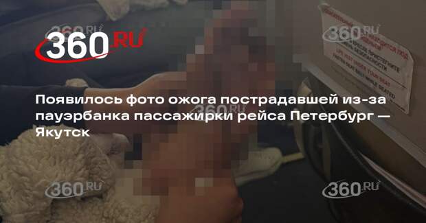 Пострадавшая из-за пауэрбанка пассажирка самолета показала ожог ступни