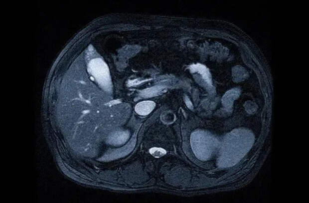 МРТ печени с контрастом: Протокол исследования очагов и холангиографии
