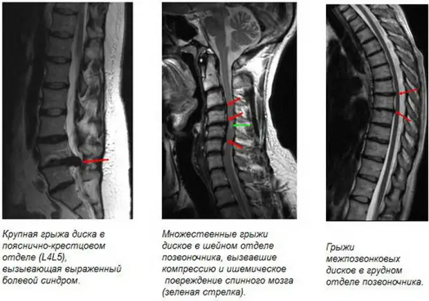 Мрт Поясничного Отдела Позвоночника Цена