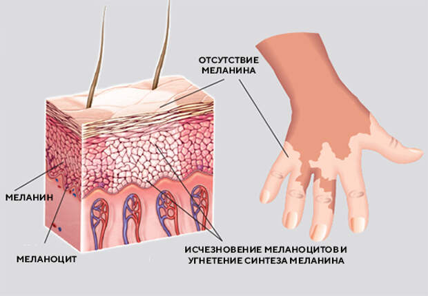 Меланин это. Строение эпидермиса меланоциты. Меланоциты строение.